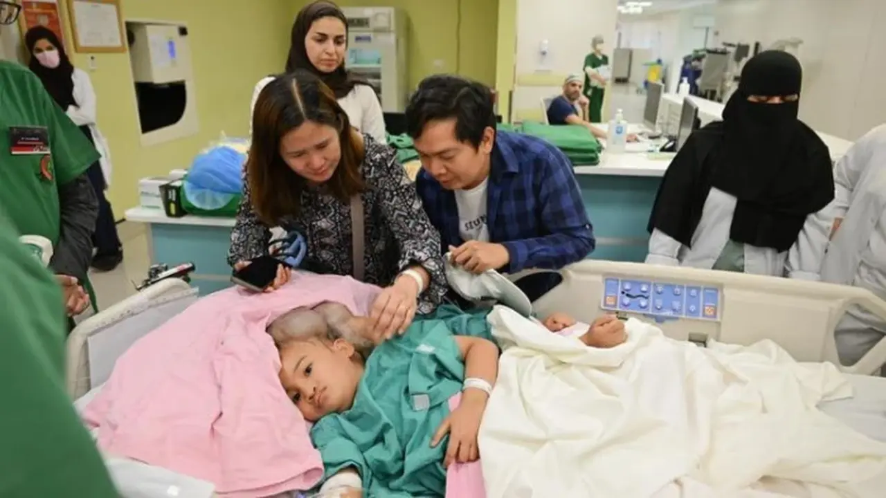 تفاصيل عملية فصل التوأم الفلبيني كليا وموريس آن ونسبة الخطر يحددها الربيعة